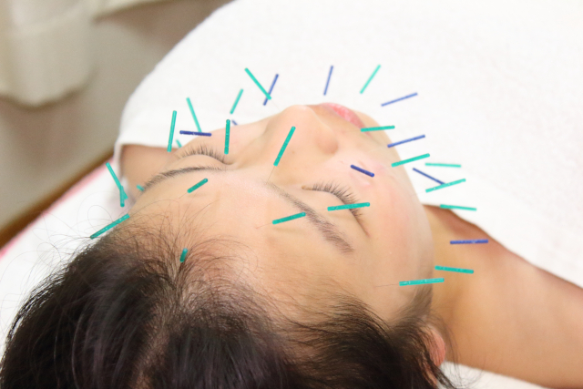 美容針を受けている女性